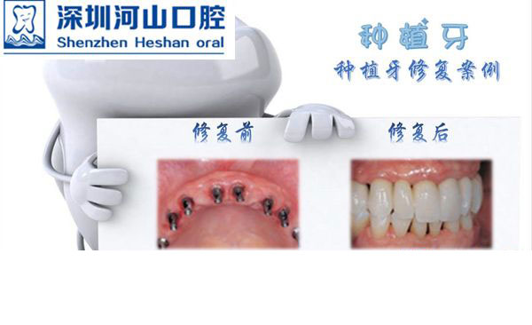 深圳世纪河山口腔医院种植牙示意图
