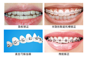 佛山拜博口腔四大矫正方式