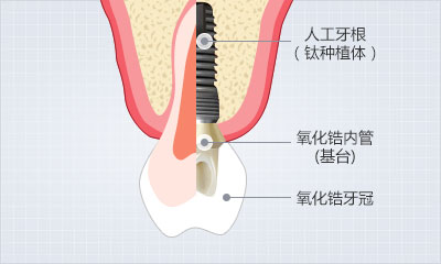 种植牙结构