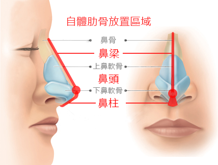 肋软骨隆鼻