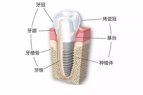 种植牙结构对比