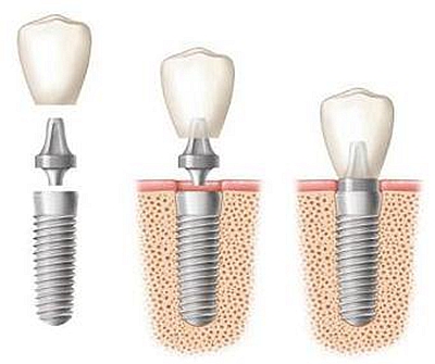种植牙过程