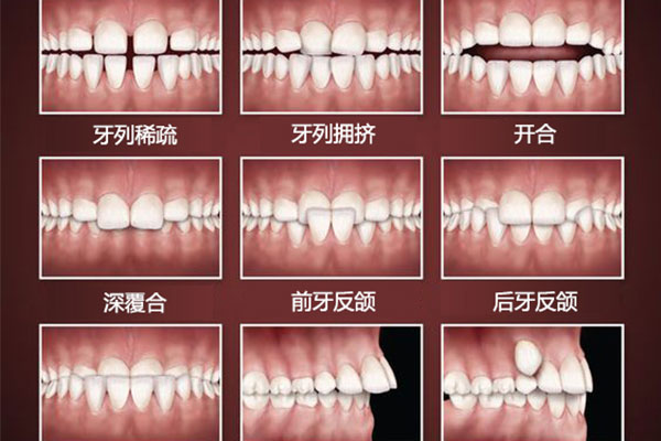 牙齿正畸各种类型