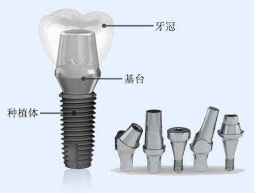 种植牙的组成部分