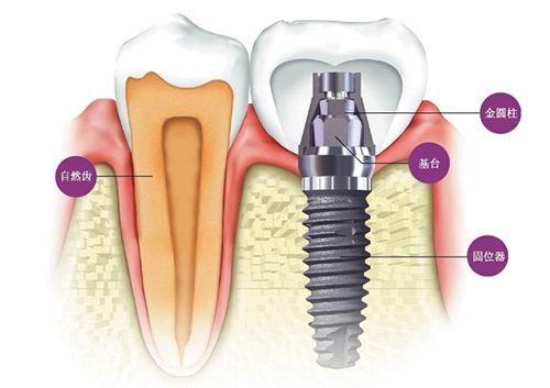 种植牙结构图