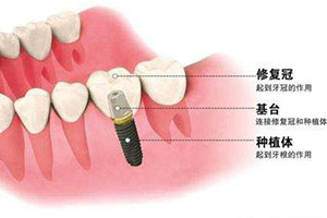 种植牙示意图