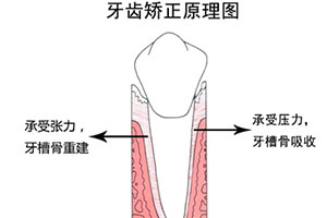 牙齿矫正原理