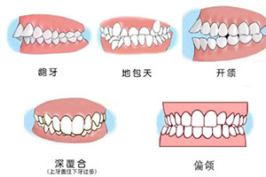 牙齿矫正的各个情况