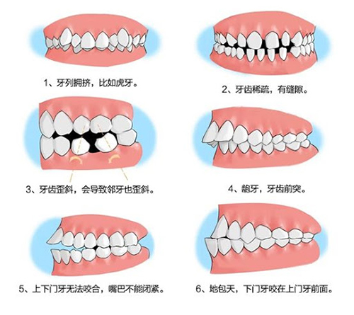 需要牙齿矫正的适应症