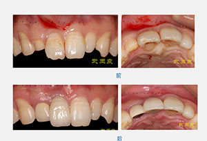 武玉良医生种植牙示意图