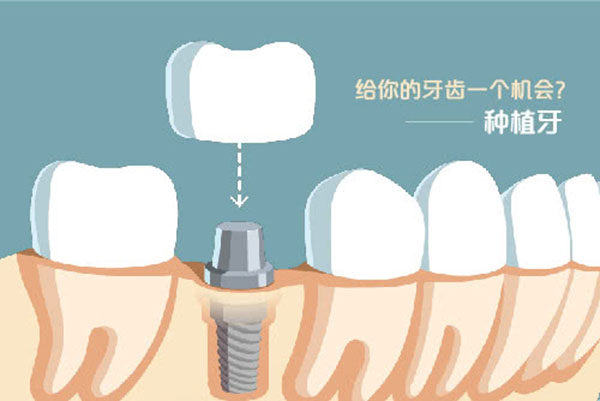 给牙齿一个机会种植牙