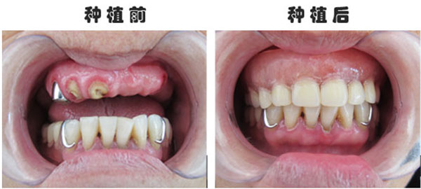 种植牙前后对比图
