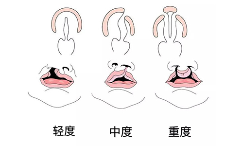 唇腭裂的程度示意图