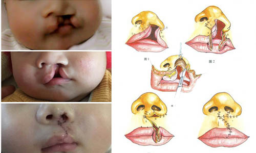 唇腭裂手术效果对比图