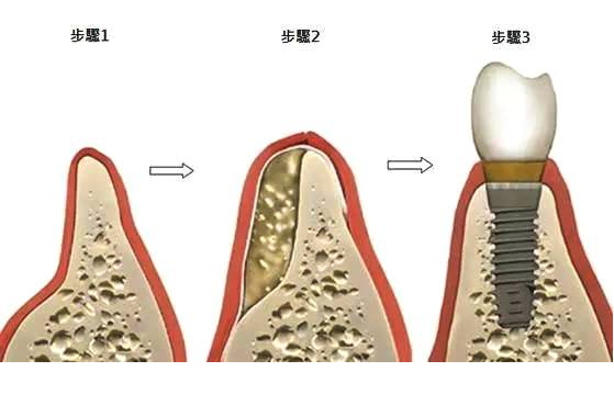 种植牙骨粉填充效果