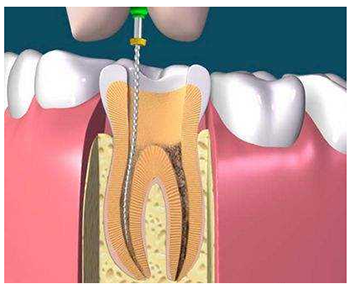 根管治疗.png