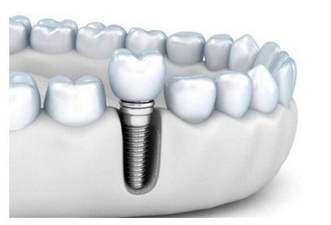 口腔种植牙简图