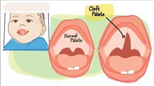 腭裂的示意图