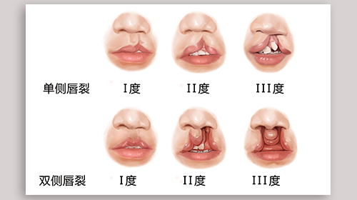 不同程度的唇裂示意图