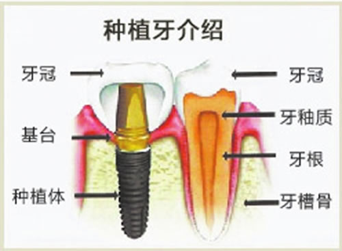 种植牙后悔经历图片.jpg