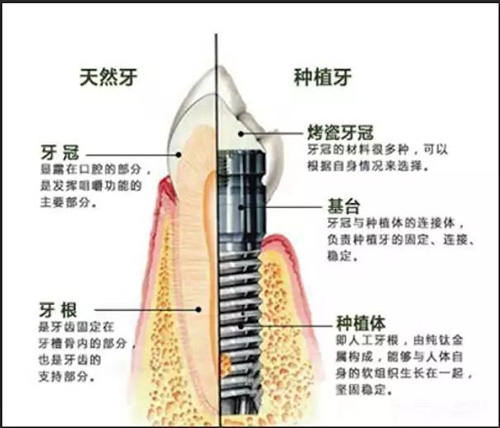 种植牙跟天然牙对比