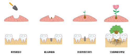 种植牙过程