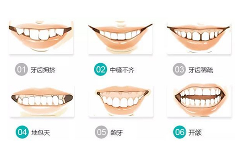 牙齿矫正适应症的示意图