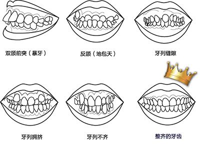 适合矫正牙齿的症状