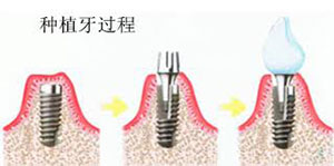 种植牙过程