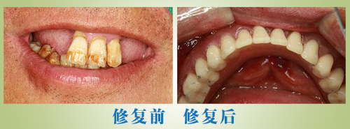 牙齿修复效果实例图