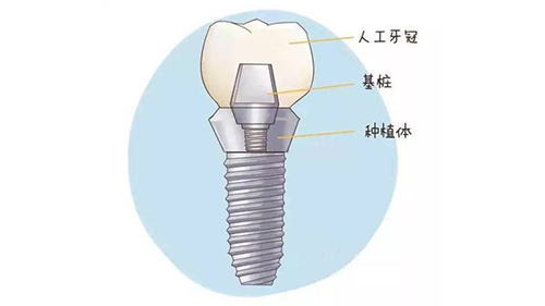 种植牙结构