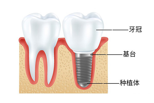 种植牙的结构