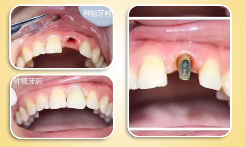 种植牙前后效果对比