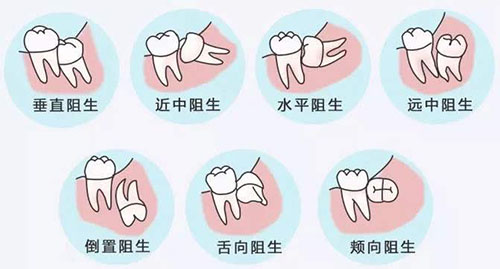 需要拔智齿的情况