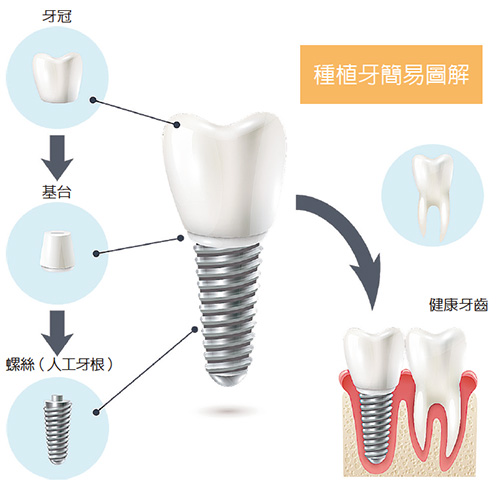 种植牙简易图解