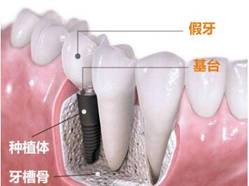 种植牙植入效果展示