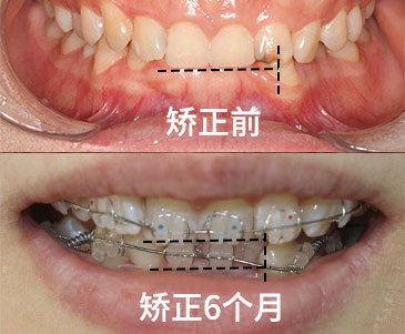 深覆合矫正前后对比图