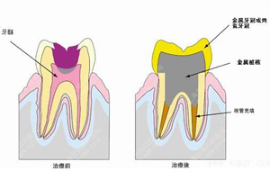 蛀牙治疗.jpg