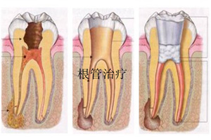 根管治疗.jpg