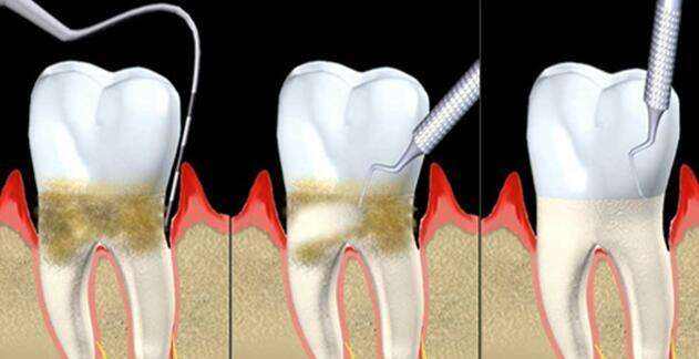 牙周炎治疗