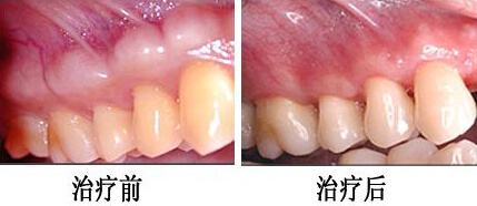 牙周炎治疗前后对比