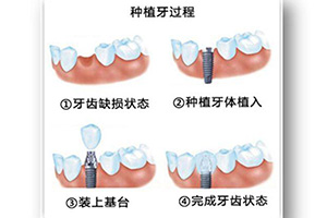 种植牙过程