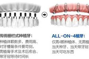 #Y*&x*b口腔科种牙怎么样?价格多少呢?