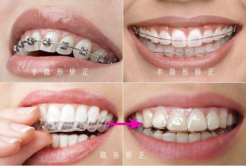 牙齿矫正方法盘点