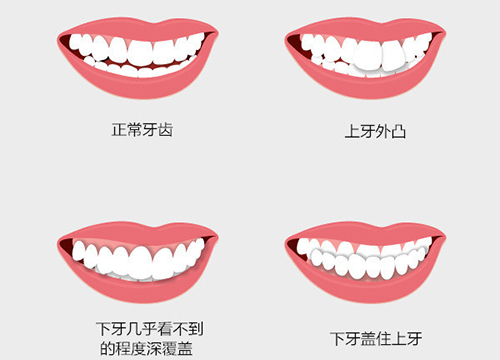 标准的牙齿咬合图片及有问题的咬合图示