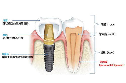 种植牙