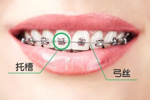 牙齿矫正方式半隐形矫正