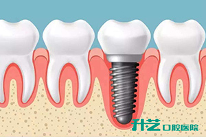 中山升艺口腔医院种植牙