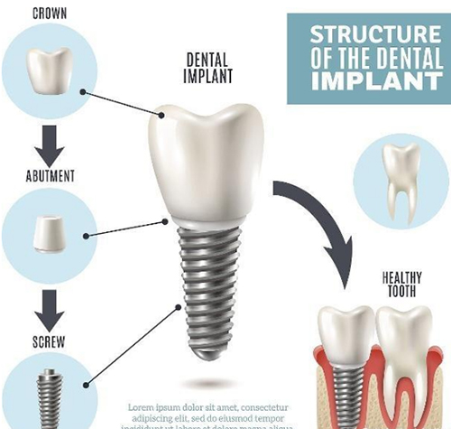 种植牙结构