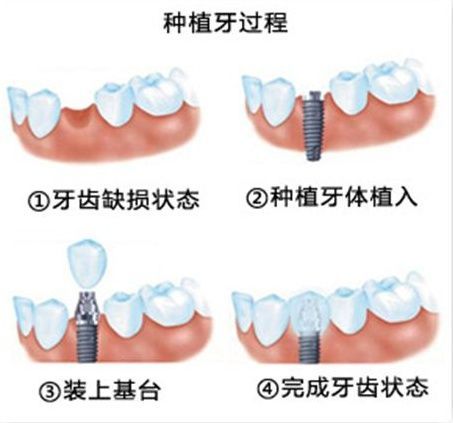 种植牙过程